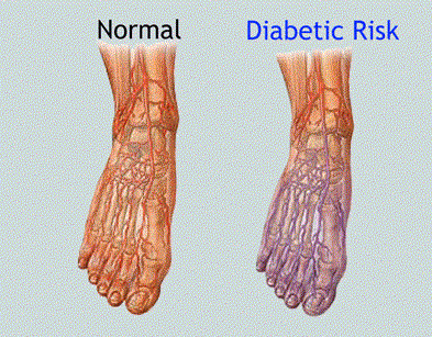 chaussure pour diabetique femme